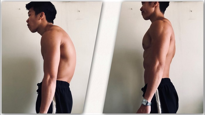 Gù lưng ảnh hưởng sức khỏe